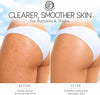 Butt Acne Treatment Cream – Clears Breakouts, Pimples, Dark Spots & Ingrown Hairs on Butto - Image 3