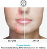 Acne Face wash Treatment with Benzoyl Peroxide - Fight Acne Blemishes on Contact for Cysti - Image 5