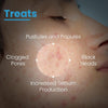 Fcl 2% Benzoyl Peroxide Face Wash, B-Prox 10 Face Wash for Acne Exfoliate Blackheads Contr - Image 5