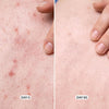 Geologie Acne Control Body Wash | 2% Salicylic Acid Acne Treatment | Helps Treat & Prevent - Image 4