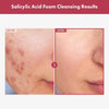 Tosowoong Salicylic Acid BHA Foam Cleanser for Oily Skin, Pores - Personal Care - Image 2