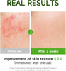 Centella Asiatica Serum Centella Tea Tree Ampoule Facial Serum Korean Centella Serum for A - Image 3