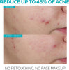 Bundle of La Roche-Posay Effaclar Salicylic Acid Treatment to Minimize Pores, Clear Acne B - Image 3