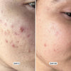 Geologie Acne Control Face Wash | 2% Salicylic Acid Exfoliating Cleanser | Clears Skin, Co - Image 3