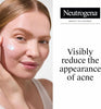 Neutrogena Rapid Clear Stubborn Acne Spot Treatment Gel, 1 oz - Image 2